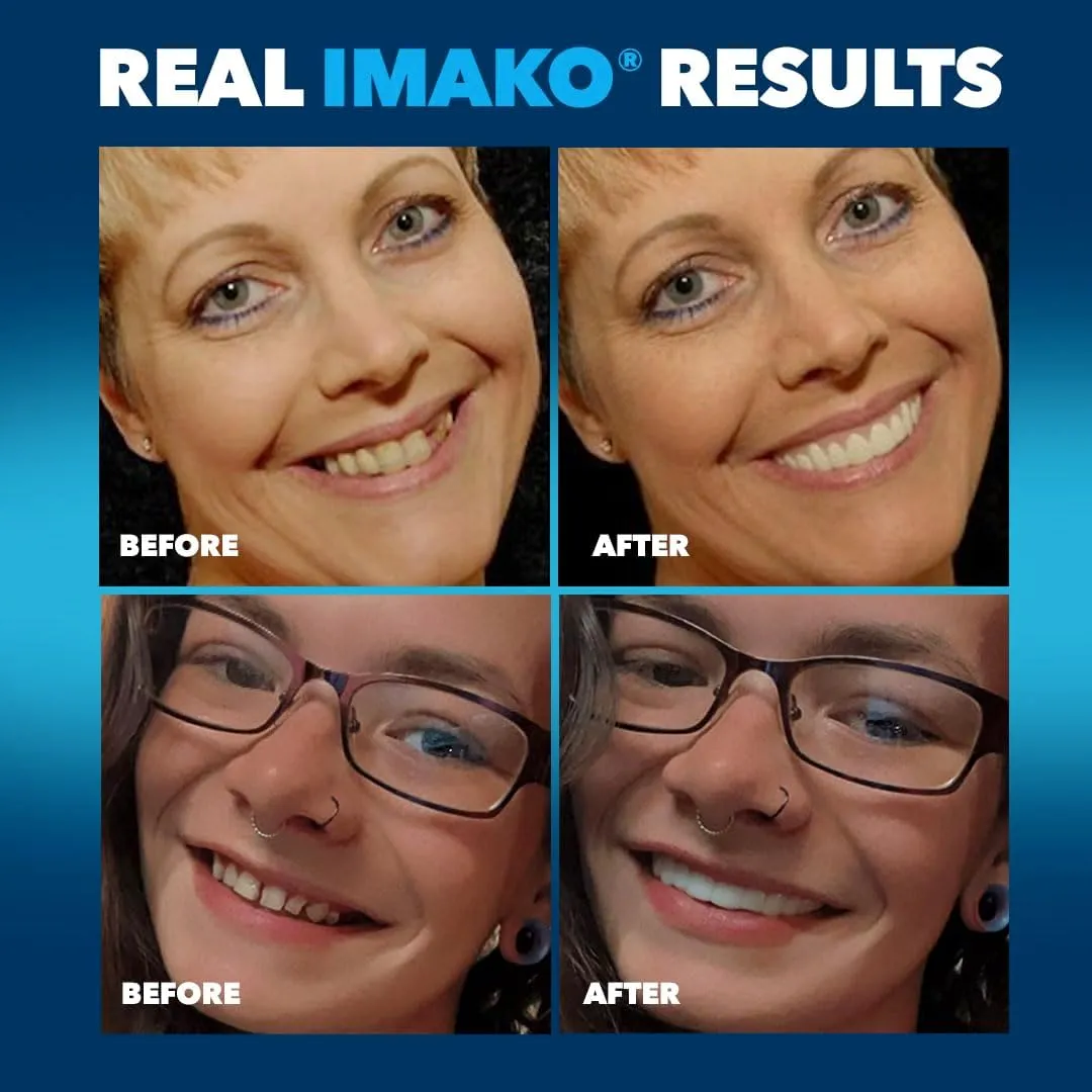 Imako Premium Cosmetic Uppers - 1 Pack - Large, Natural White - DIY Smile Makeover - Made in USA